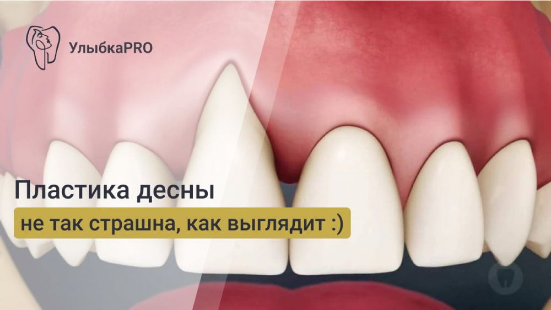 Пластика десны что это такое и зачем её делать