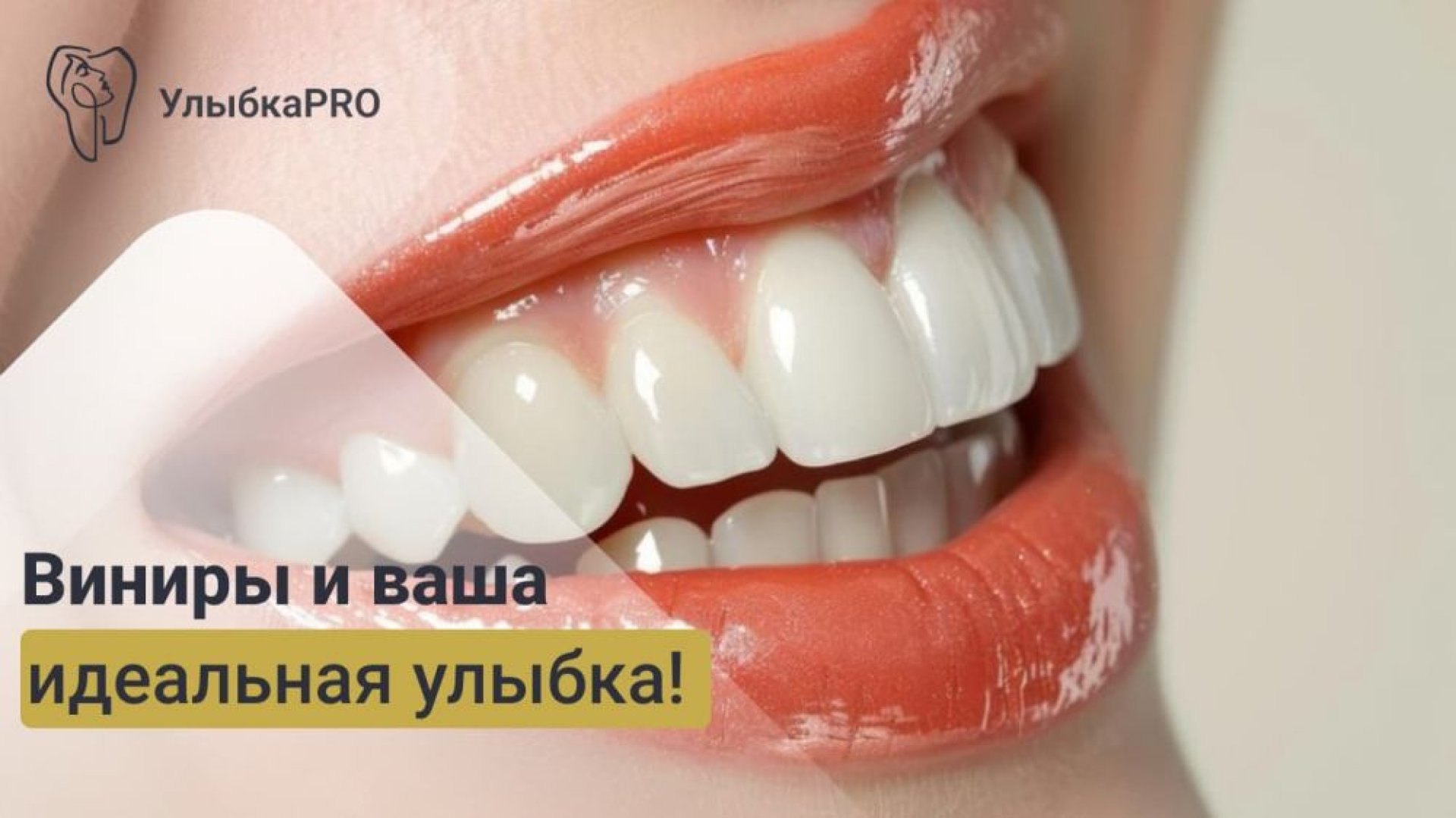 Процесс установки виниров от консультации до идеальной улыбки