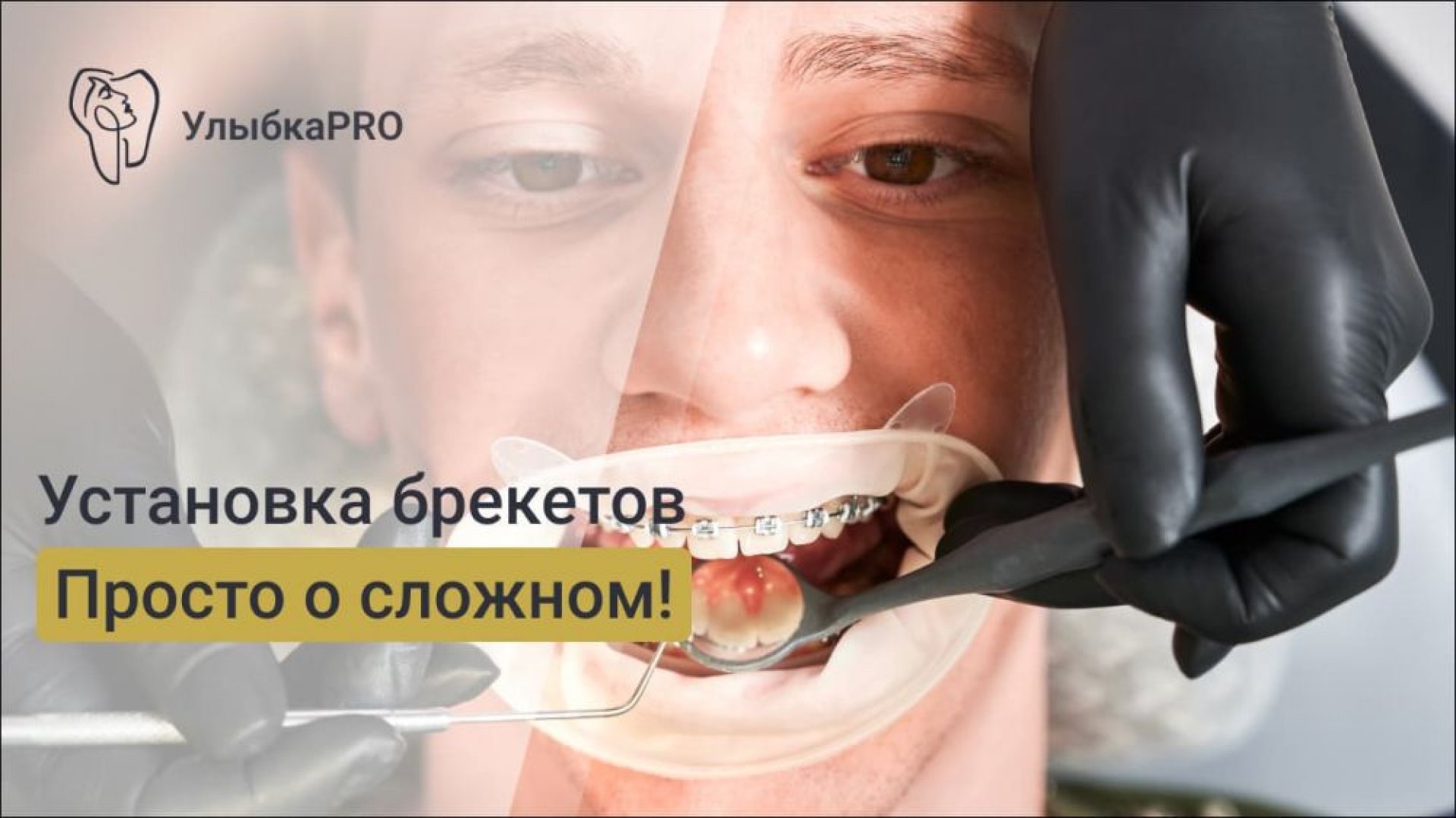 Установка брекетов этапы процедуры