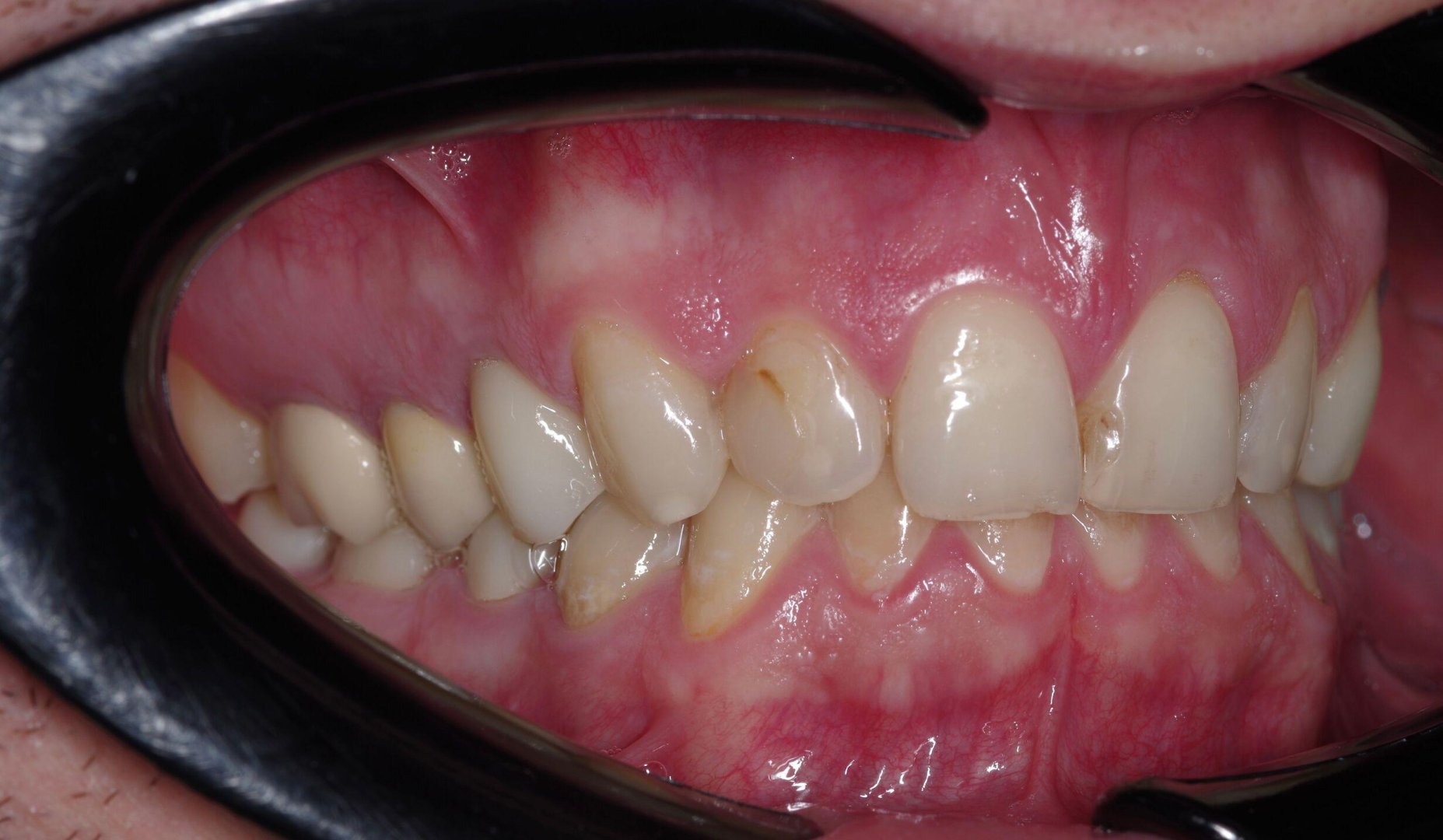 Виниры E.max — до лечения