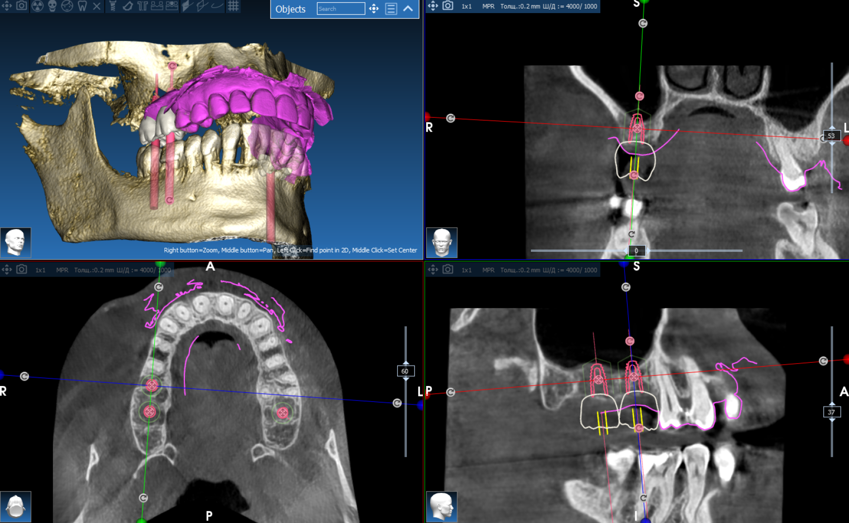 Хирургический шаблон для имплантации - вид 2
