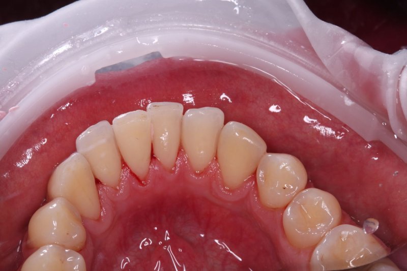 udalenie-naleta-ot-kureniya-gbt-rabota-2