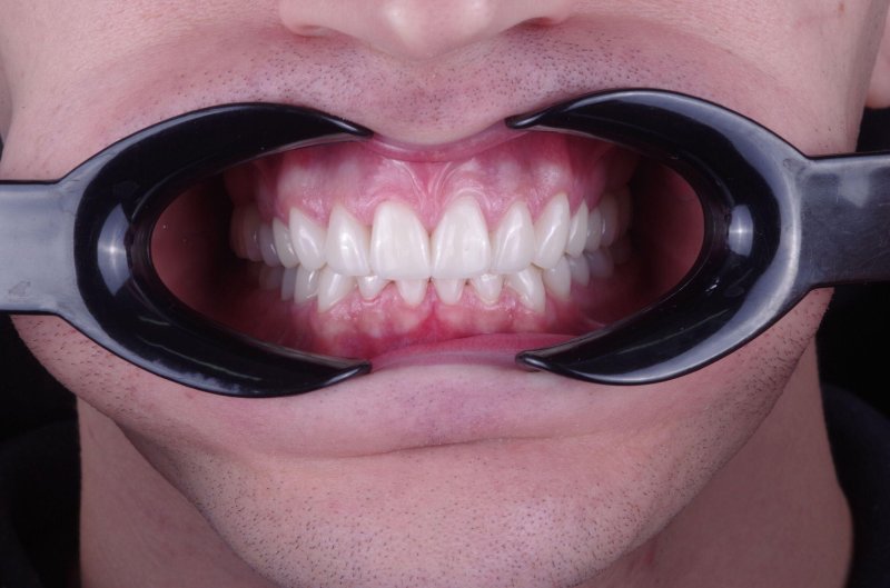 keramicheskie-viniri-foto-do-posle-7