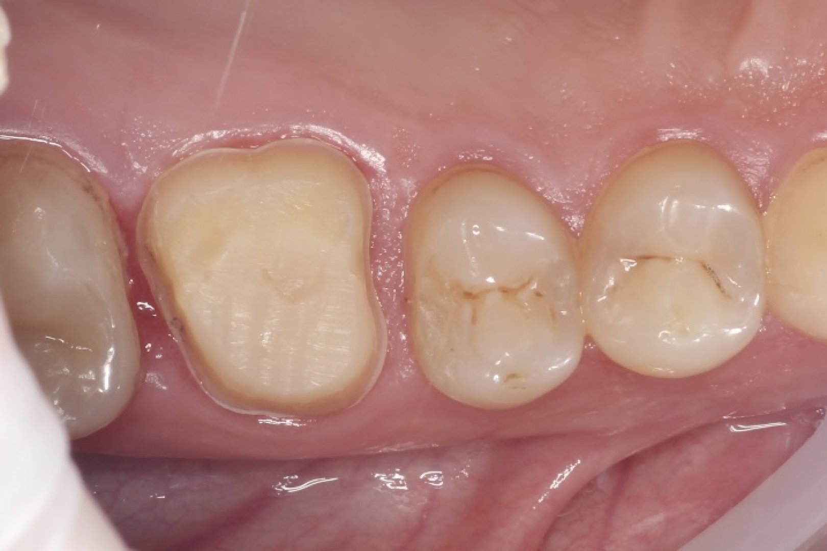 Временная коронка_before