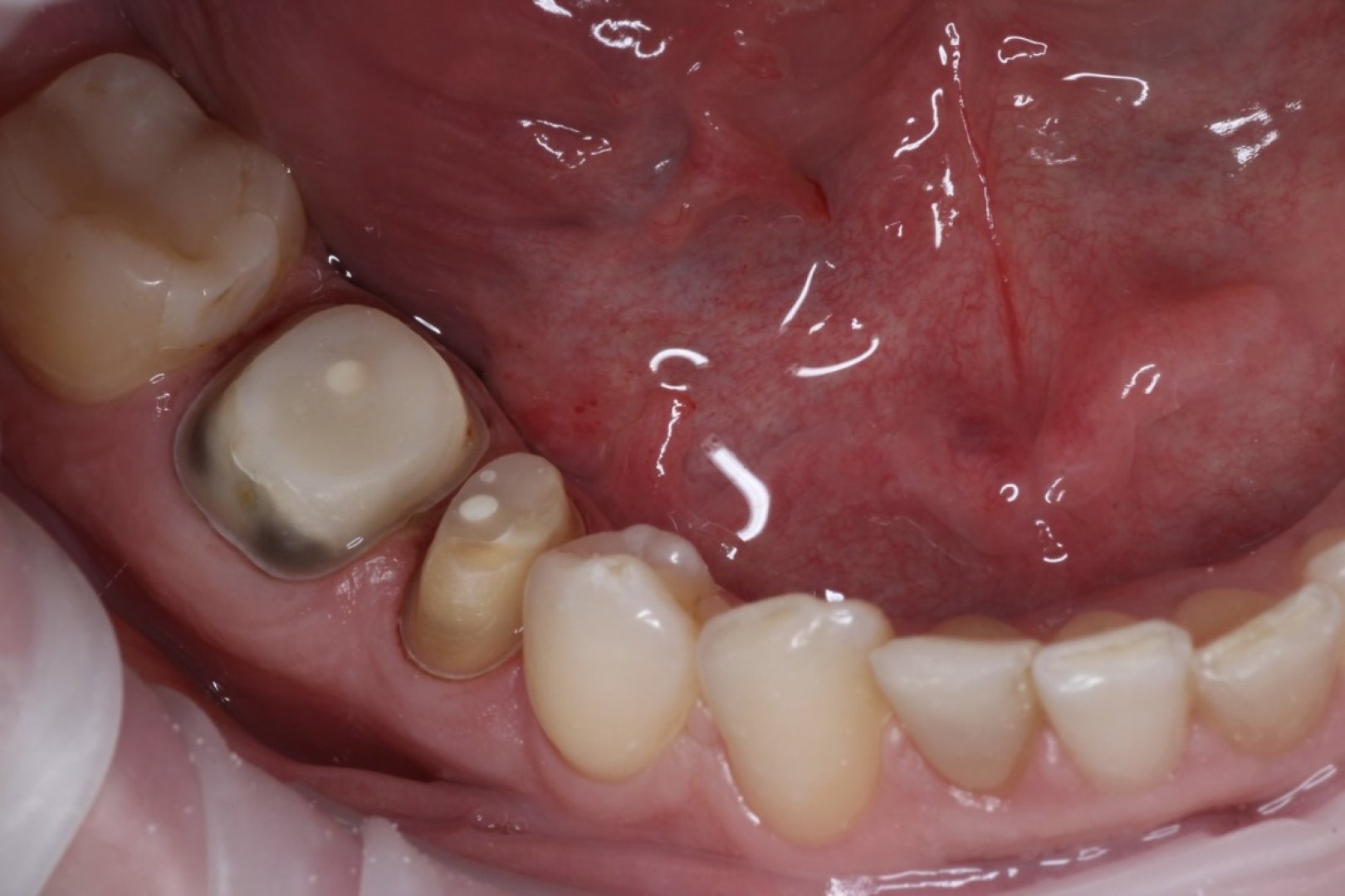 Коронки на зубы 45, 46 _before