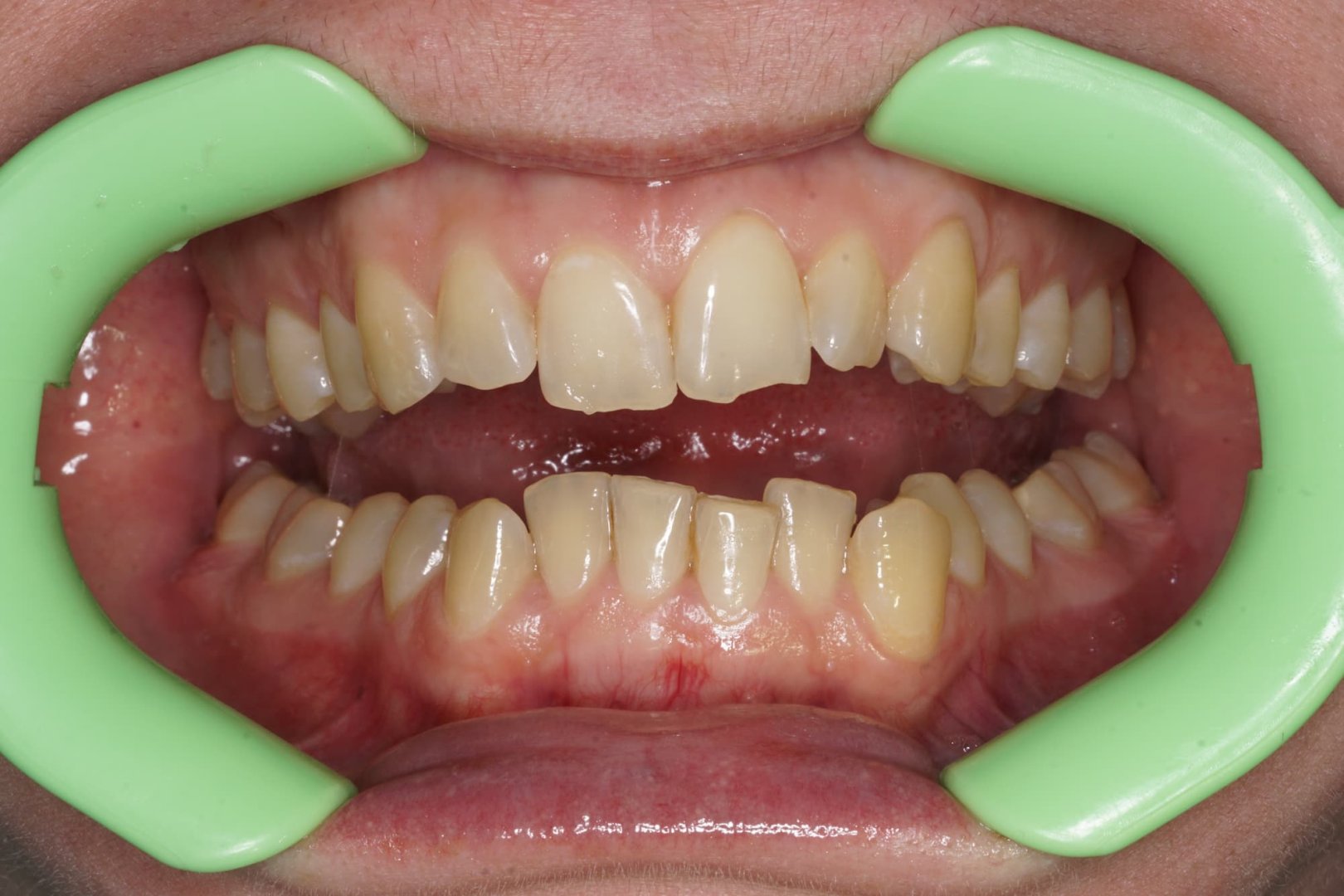 Лечение на элайнерах. Кейс 2_before