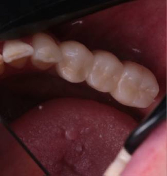 postoyannye-koronki-na-dva-implantata-sleva-and